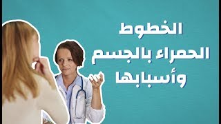 الخطوط الحمراء بالجسم وأسبابها #موضوع