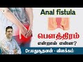 பௌத்திரம் என்றால் என்ன? | Anal fistula | Explained | Dr. Madhusudhanan J