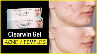 Clearwin Gel For Acne | Glass Finished Skin | Remove Acne in 7 Days #RemoveAcne #ClearSkin