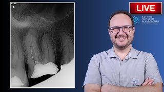 Rtx of 🦷16 with Separated Instrument and AAP ▶️ Part 1 | CASE201