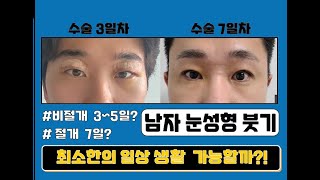 [모티브 성형외과] 남자 눈매교정 붓기,  절개  2명 비절개 2명 수술당일~ 1개월 셀카로  알기 쉽게 집중 분석!!  # 눈성형 유명한 곳 # 무쌍 눈매교정 # 속쌍 눈매교정