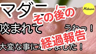 マダニに咬まれて大変な事になりました。経過報告