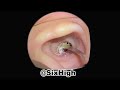 6 giant clogged hard fossilized earwax comfortable relaxation asmr