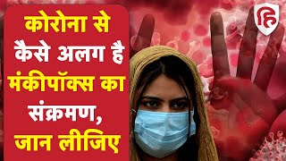 Monkeypox Vs Corona: मंकीपॉक्स और कोरोना के संक्रमण के लक्षणों में क्या अलग, जानें जरूर बातें