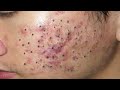 Blackhead Removal With Sac Dep Spa @10006924