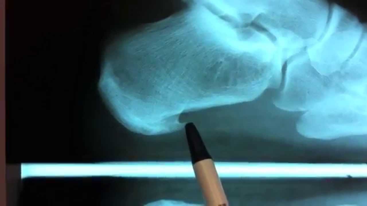 Heel Spur & Plantar Fasciitis Surgery | Heel Pain Treatments - YouTube