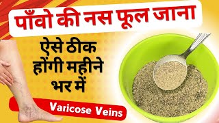 पाँवो की नस फूल जाने (Varicose Veins) की समस्या को ऐसे ठीक करें महीने भर में Get Cure Varicose Veins