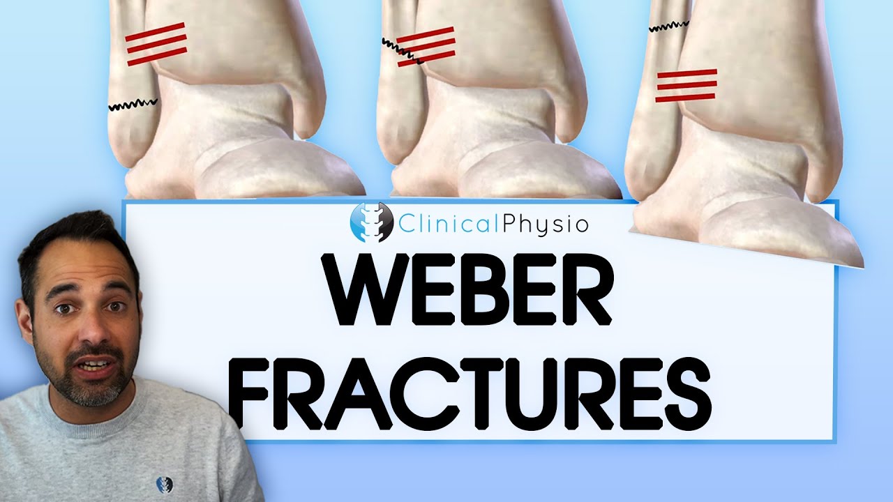 What Is A Weber Ankle Fracture? | What They Are, Key Things To Know ...