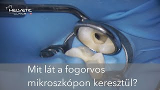 Mikroszkópos gyökérkezelés  - mit lát a fogorvos kezelés közben?