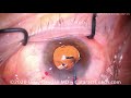 should you use a trifocal iol in fuchs corneal dystrophy