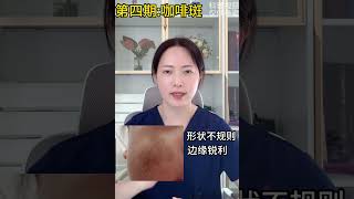 教你如何辨别咖啡斑？激光治疗效果好 恢复快！