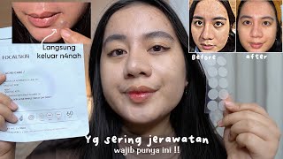 YANG SERING JERAWATAN WAJIB PUNYA INI ! REVIEW FOCALSKIN ACNE CURE PATCH