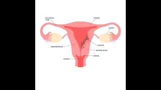 Endometrial Cancer (Cancer of Endometrium) ; Definition, Causes, Symptoms, Diagnosis, Treatment