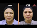 Mela Peel Forte Treatment with Xeoul Clinic Subang Jaya | Melasma Pigmentation Spots &  Brightening