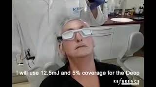 Dr. Matteo Tretti Treating Wrinkles with AcuPulse | Lumenis