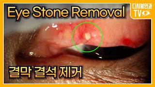 Eye Stone Removal