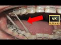 💝HOW #BRACES WORK - TIMELAPSE of  Scissors Bite: A 9-Month Transformation in adult in 4k!