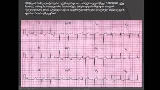 ეკგ / გულის იშემიური დაავადება / სისტოლური შუილი / აორტული სტენოზი, აორტის ხვრელის სტენოზი