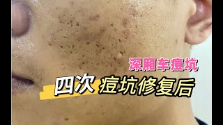 同步改善深厢车型痘坑加痘痘问题，4次综合激光后