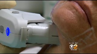 Simple Procedure Treats "Turkey Neck" Without Surgery