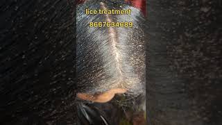 How to remove nits and lice #nits #coimbatore #lice #headlice #haircare #headliceremoval #peenu #eru