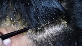 Dandruff scratching removal on head using black combing#1169