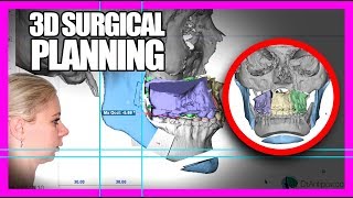 3D Orthognathic Surgical Planning - HOW ITS DONE