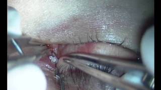 Repair of canalicular laceration with Mini-Monoka lacrimal stent