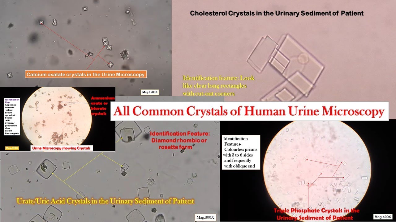 All Common Crystals Of Urine Microscopy Introduction, Identification ...