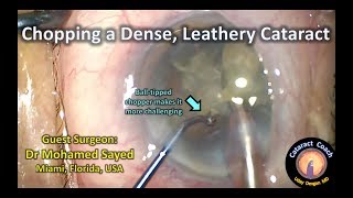 CataractCoach.com guest surgeon shows us a dense, leathery cataract