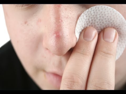 How to Treat Pimples Overnight How to Treat Pimples Overnight