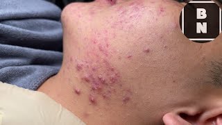 Acne On Teen Cheek [FULL] | Acne Treatment Bo Nguyễn Spa 2025