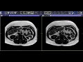 how to read a liver mri