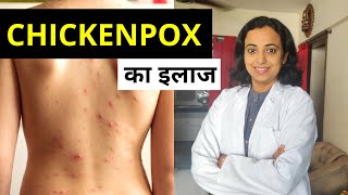 Chickenpox Treatment in Hindi | Chicken Pox का इलाज कैसे करें?
