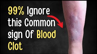 Most People Ignore These Common Signs of a Blood Clot!