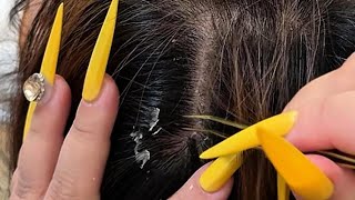 Deep Scalp Cleaning with Nails and Tweezers | ASMR for Sleep