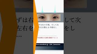 アトピー性皮膚炎の眼瞼下垂。治療を断られることが多い　#眼瞼下垂症　#挙筋前転　#眼瞼下垂手術