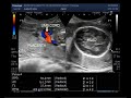 Ultrasound Video showing extreme of Oligohydromnios is Anhydramnios.