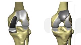 Outcomes \u0026 Benefits of Robotic Joint Replacement Surgery with Dr. Charles Rutherford