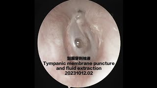 （去色版）鼓膜穿刺抽液Tympanic membrane puncture and fluid extraction20231012.02