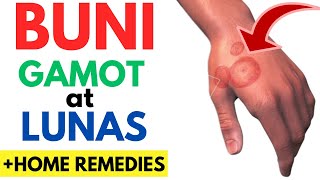 Gamot at Lunas sa BUNI | Sanhi, Sintomas ng BUNI sa BALAT | Home Remedies, Ointment, Para Mawala