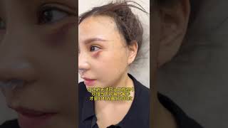 谁不喜欢看漂亮的女人？你不喜欢吗？爱美有什么错？ #facelift #fyp #trending #beautiful #viral #整形 #beauty #plasticsurgeon #醫美