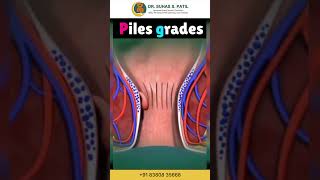 Piles Grading Explained Proctology Dr Suhas Patil