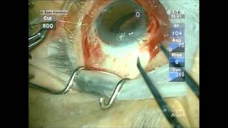 Iol Suturing,Scleral fixation of foldable Iol,Hoffman Technique.