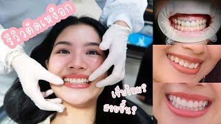 รีวิว ตัดเหงือก 🦷 เจ็บไหม? สวยขึ้นไหม? ตัดดีไหม? | ChanyaChannel