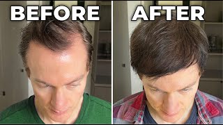 How I Reversed My Hair Loss + Greying