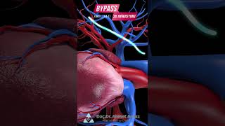 ByPass Ameliyatı 3D Animasyonu #bypass #kalpcerrahi #kapalıbaypass #shorts  #türkiye