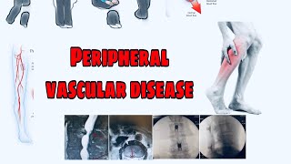Peripheral arterial dieseas | causes,risk factors,differential daignosis,investigation,management