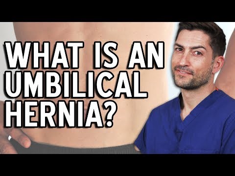 Umbilical Hernia - Everything You Need To Know! Umbilical Hernia - Everything You Need To Know!