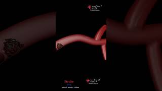 Ischemic Stroke By A Blood Clot | CVA | Cerebral Vascular Accident | Animation